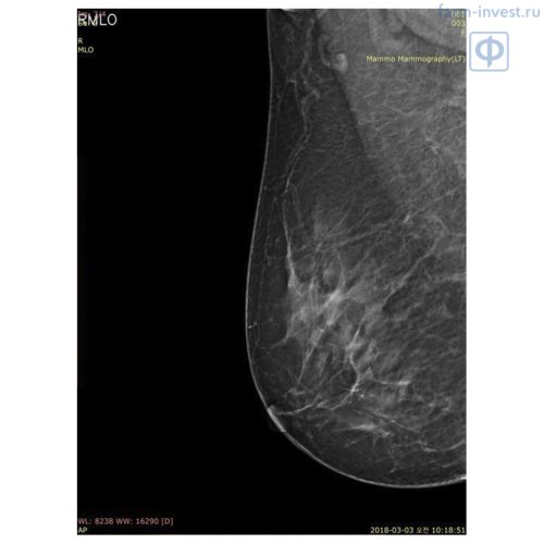 Маммографическая цифровая система DМХ-600